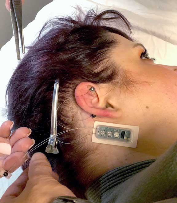 Neurostimulator demonstration